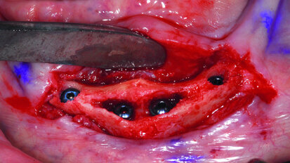 Brain-guided implant reconstruction: Who makes the decisions?