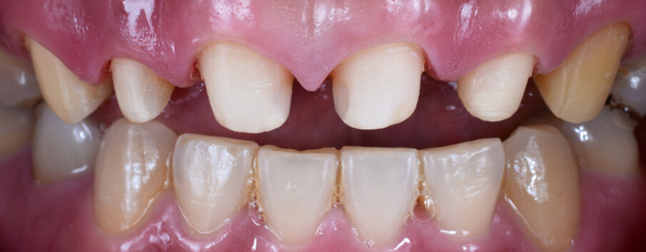Fig. 3: Situation after the removal of caries lesions and root canal treatment
