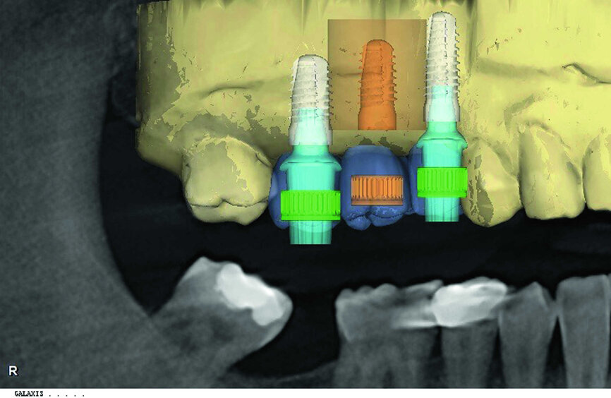 Fig. 3 : Planification 3D : superposition des données. 