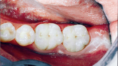 Gli scienziati dichiarano che la CUS è una malattia autoimmune