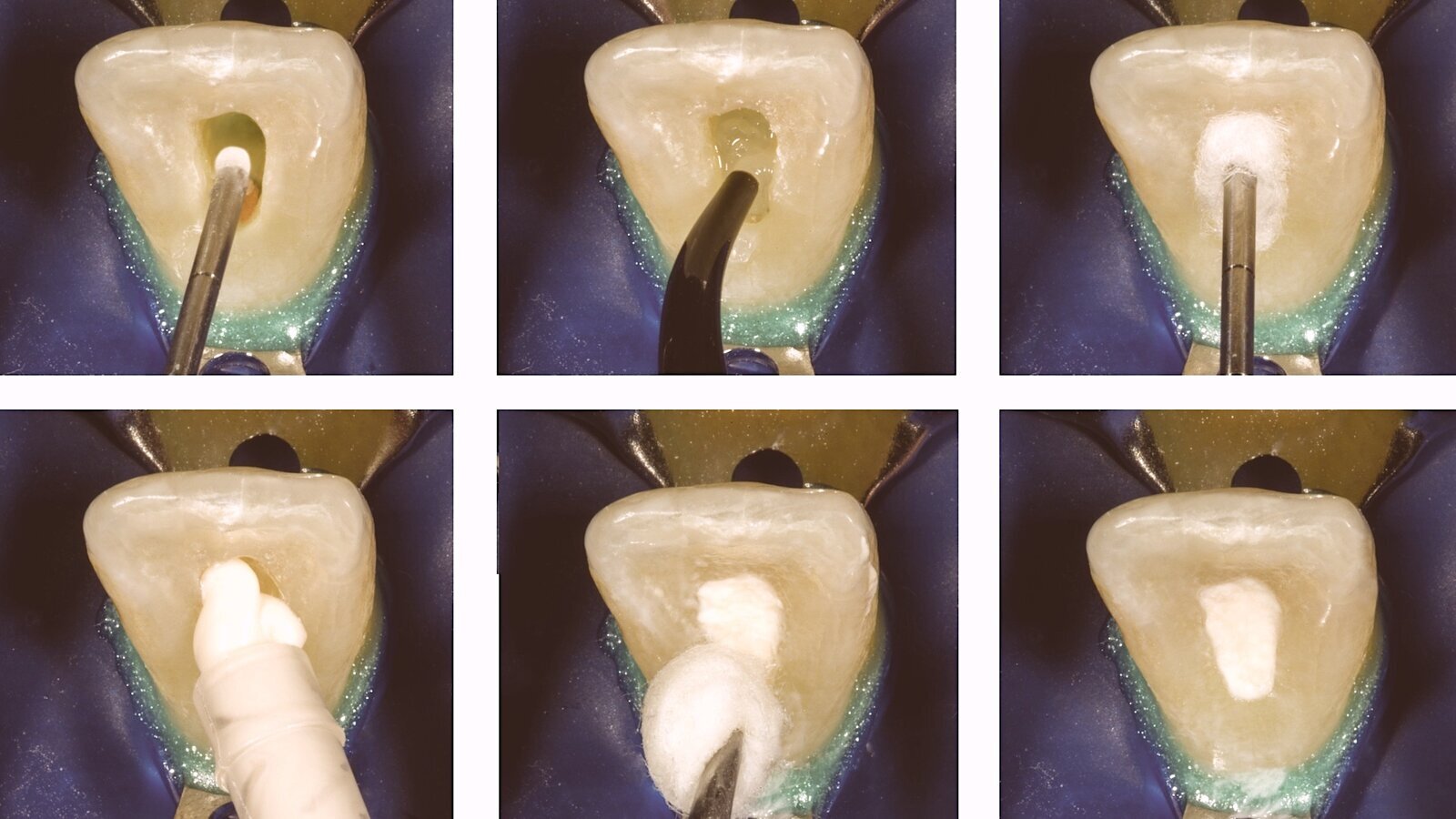 El aclaramiento dental no es un juego