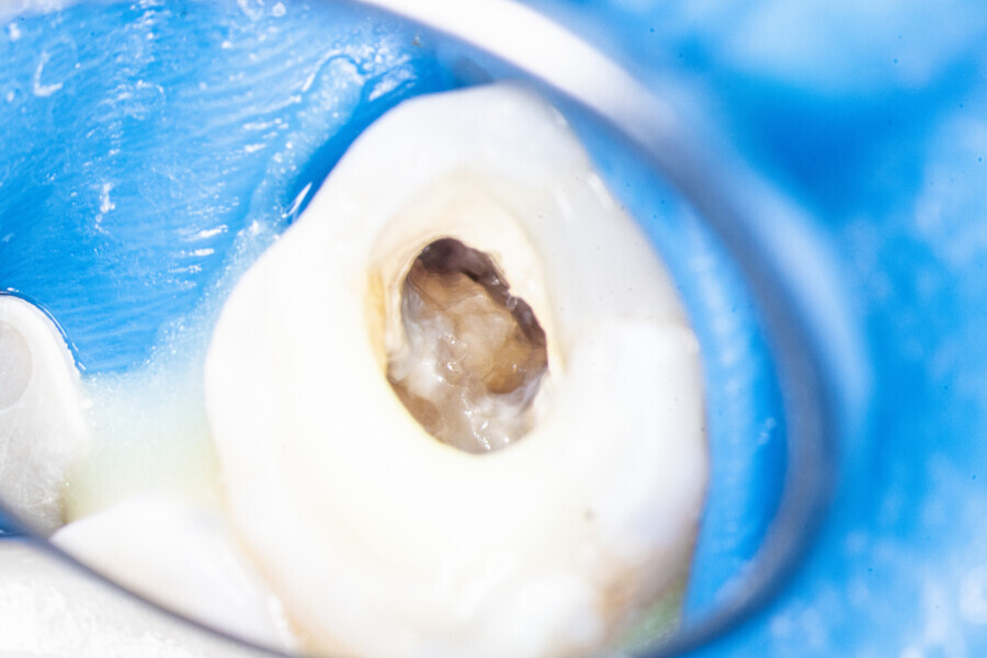 Fig. 17: The MB1 canal and isthmus. Stage of locating the MB2 orifice in the first molar.