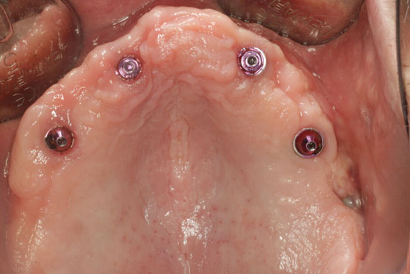 Fig. 24. Aspecto de la mucosa al aÃ±o de la carga. ObsÃ©rvese el grado de salud periimplantaria asÃ­ como el cierre completo de la comunicaciÃ³n. 