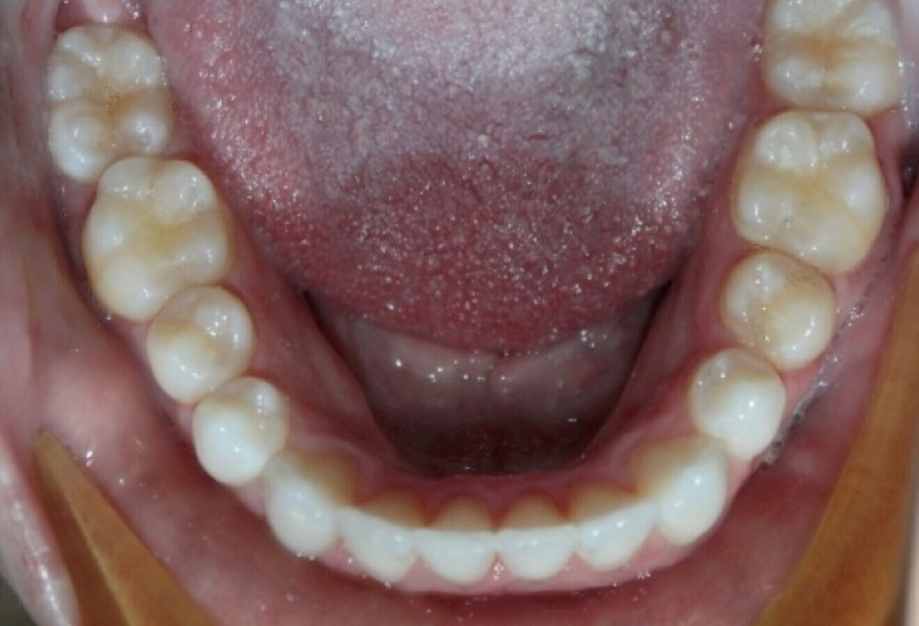Fig. 3: After four months of de-rotation.