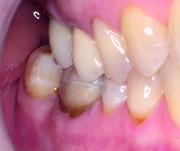 Fig. 17: Occlusal adjustments and articulation confirming the astonishing results.