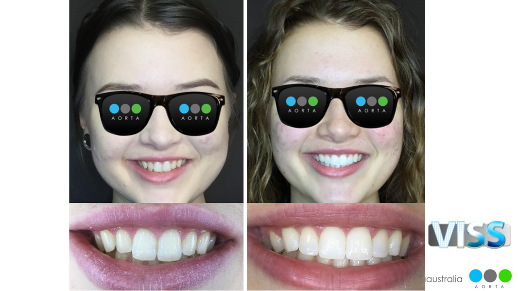 Fig. 50: The result after veneers, soft-tissue recontouring and whitening.