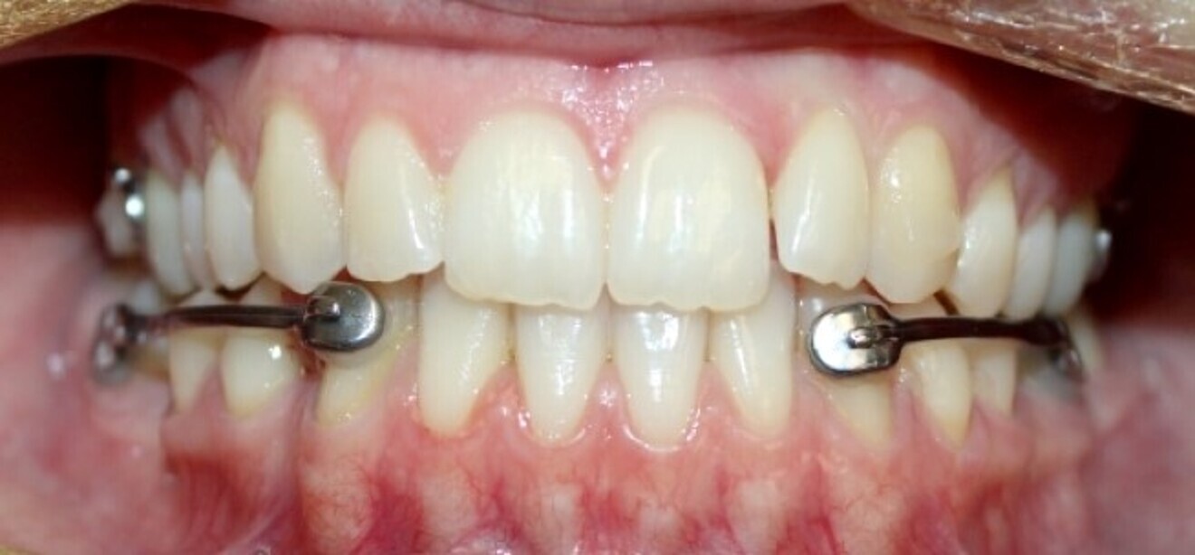 Fig. 22: After six months of the Carriere Motion appliance and aligners.