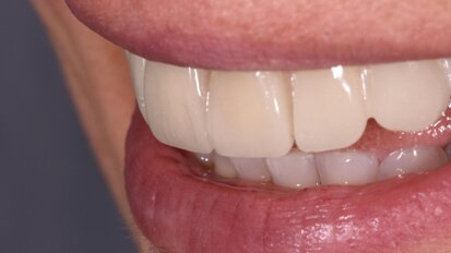 Ozonoterapia odontoiatrica ed estetica dentale: un connubio chimico e biologico