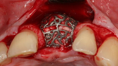 Individualized CAD/CAM-produced titanium scaffolds for alveolar bone augmentation