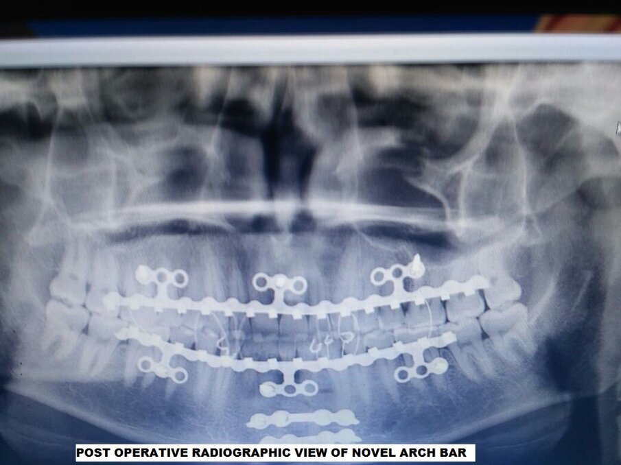 Fig 2: Post-op radiographic view of Novel Arch Bar