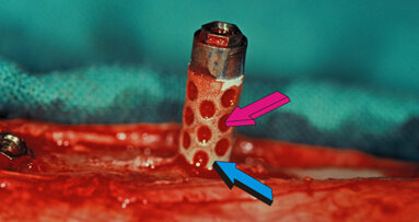 Impianti osteoinduttivi