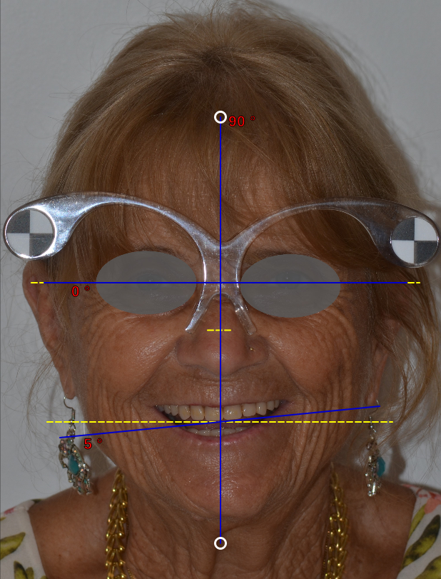 Fig. 1a - Sulla foto correttamente centrata è possibile tracciare con facilità le linee di riferimento estetico orizzontali e verticali. Ad esempio la linea mediana, la linea bipupillare e l’andamento del piano incisale.