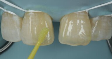 Midline diastema closure with direct composites
