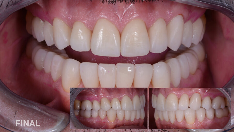 Fig. 2: Situación final, imagen intraoral: vista frontal/lateral. Coronas, carillas y overlays elaborados con composite nanohíbrido fresado.