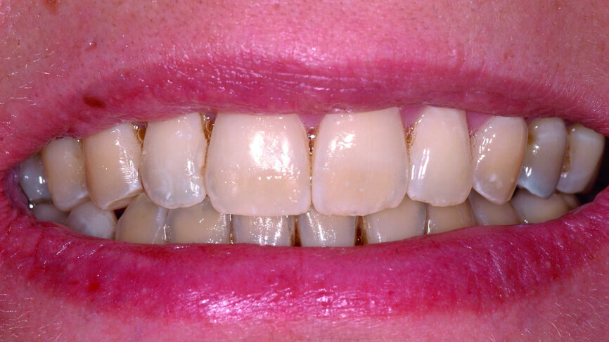 Fig. 19 : Sourire final. 