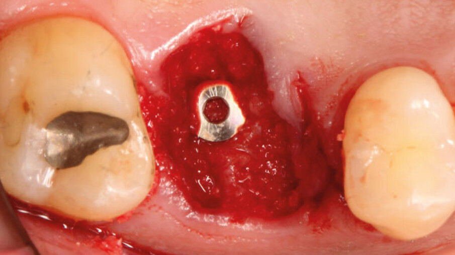 Fig. 4 - Inserimento implantare con zappatura del gap con Bio-Oss.