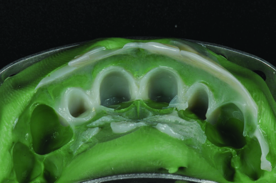 Fig. 5: Making the temporary restoration with 3M™ Protemp™ 4 Temporization Material and a silicone matrix.