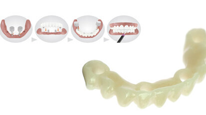 Il ponte Immediate Smile® offre a pazienti e dentisti qualcosa per cui sorridere