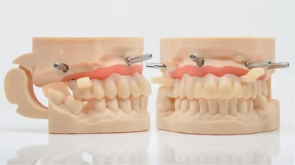 Stampa 3D in odontoiatria: tecniche avanzate per modelli, corone e abutment su Ti-Base