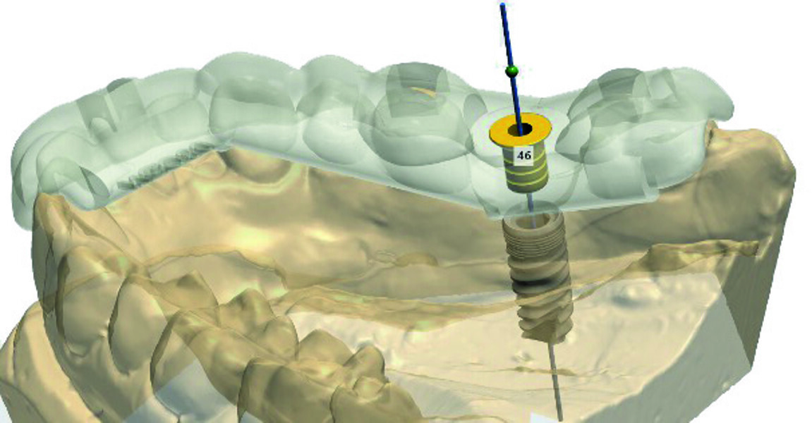 Fig. 8 : Choix et prévisualisation du positionnement de la douille MIS correspondant à l’implant choisi, en vue interne.
