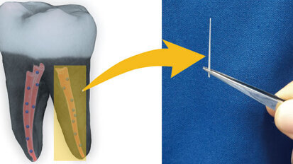 Nanodiamonds might prevent tooth loss after root canals
