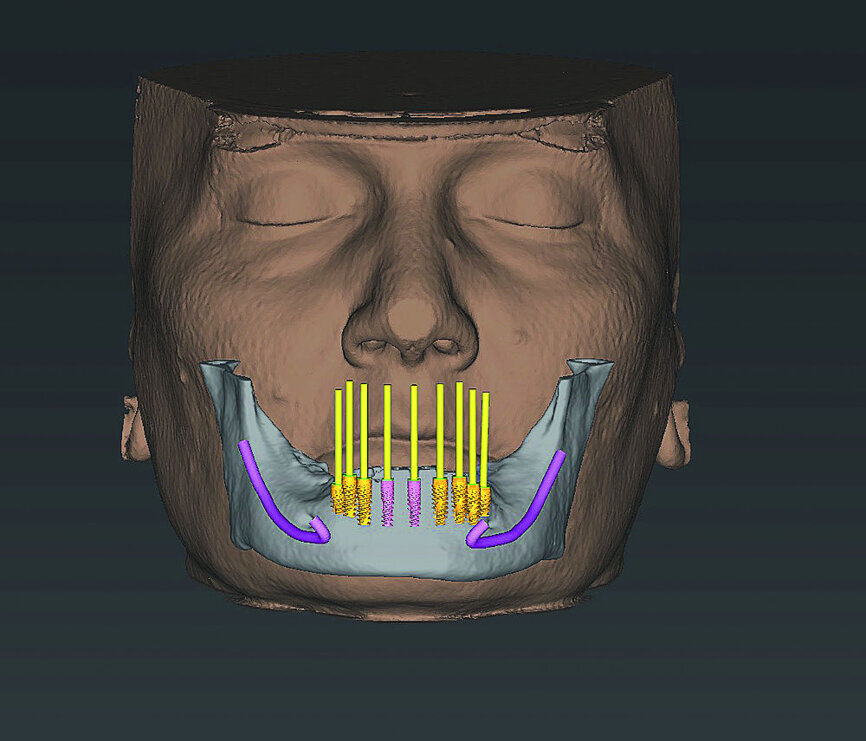 Fig 6 Analyse dento-faciale du traitement implantaire proposé dans l’arcade mandibulaire
