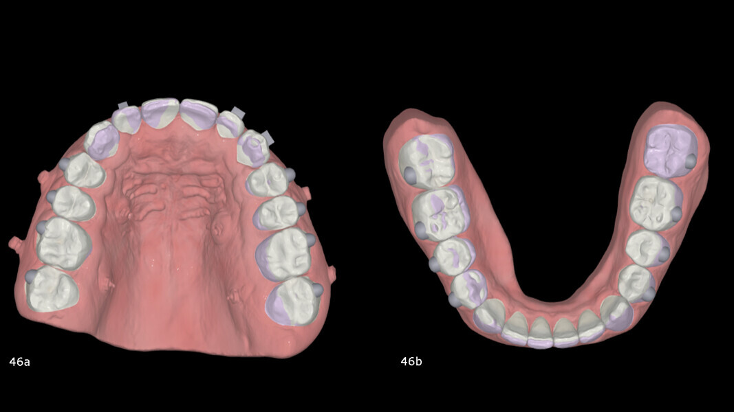 Figs. 46a & b: 3D superimposition of the planned movements with aligners.