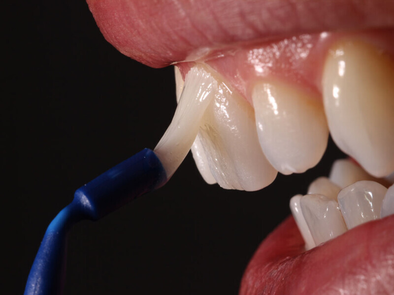 Figura 12. Barniz Profluorid para el tratamiento de hipersensibilidad dental.
