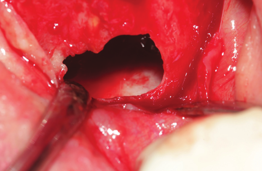 Figure 24: Bone cavity showing extended bone loss. 