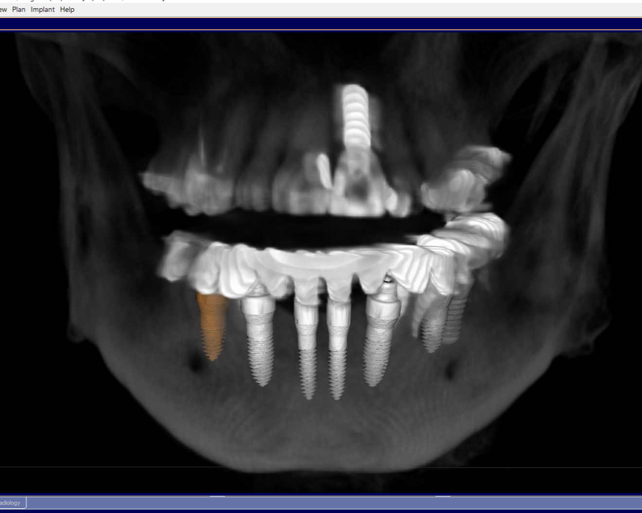 Fig. 3: 3D implant planning with the Galileos software.