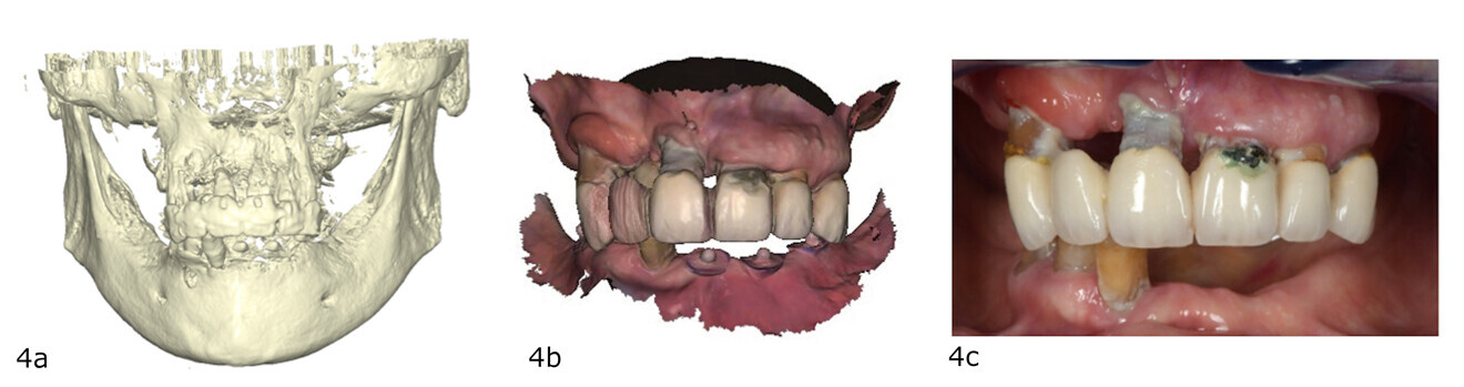 Figs. 4a–c: Combination of the various essential files to collect all the data necessary for the diagnosis, treatment plan and proper execution of the plan. CBCT (DICOM; a). Intra-oral scan (STL; b). Intra-oral photograph (JPEG/MPEG; c).