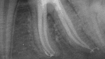 Clinical opinion: Well-thought-out simplicity leads to superior obturation