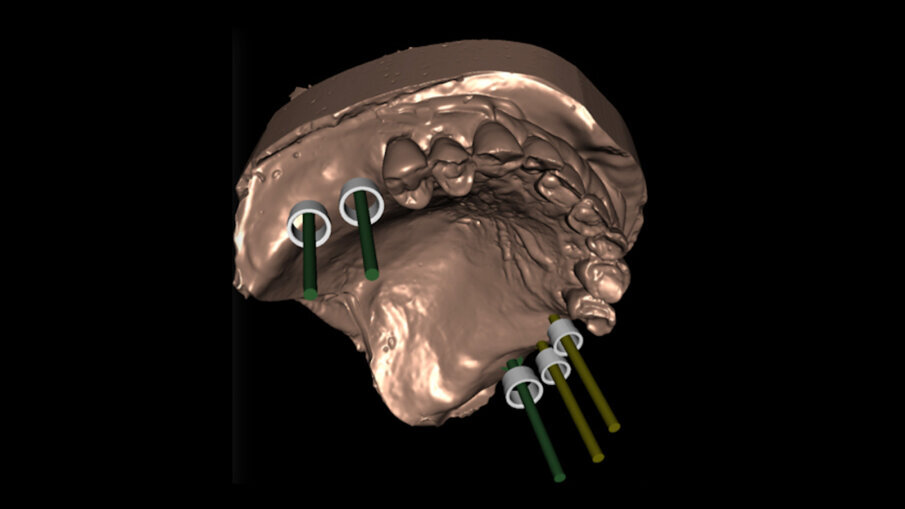 Obr. 14a, b: Digitální plánování implantátu: 2D (a) a 3D (b).