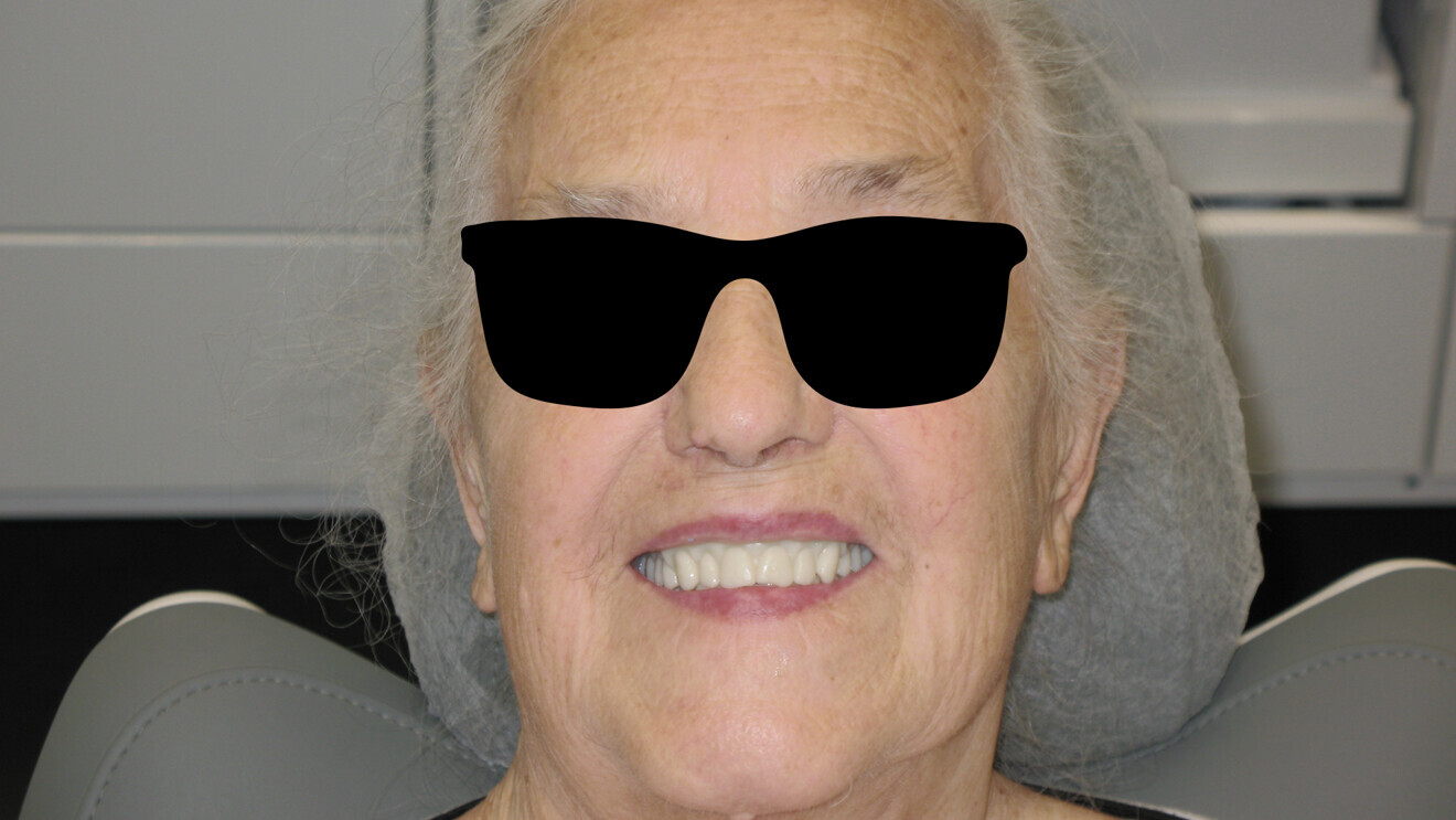 Fig. 9 : Sourire avec la maquette imprimée en 3D.