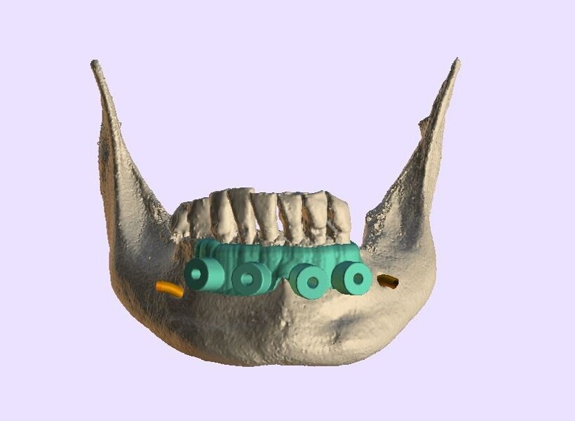 Fig. 7a: Bone reduction guide design.