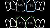 Figura 2. Proporciones reales e ideales de los incisivos centrales.