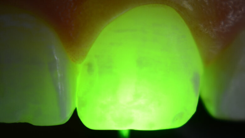 Foto 3. Diente 21. Se observa el color tenue de las manchas blancas con una profundidad de menos de 200µ, y colores más intensos en la región distal, que indican manchas de mayor profundidad.
