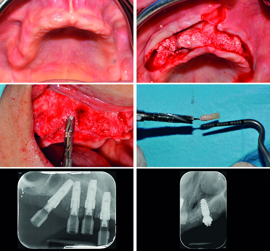 Figg. 4a-4f_A 8 mesi dall’intervento di ridge preservation, si può apprezzare l’ottimo aspetto dei tessuti molli prima del posizionamento implantare (a), eseguito aprendo un lembo a tutto spessore (b) e prelevando alcuni campioni ossei per la successiva analisi istologica (c, d), posizionando cinque impianti osteointegrati (e, f). 