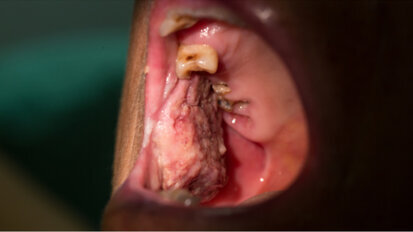 Oral cancers may go undetected during COVID-19 crisis