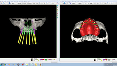 Immediate restoration in the fully edentulous maxilla region