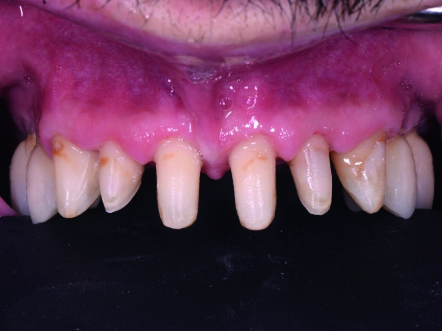 Fig. 4 : Préparations des dents antérieures supérieures pour la pose des couronnes unitaires. 