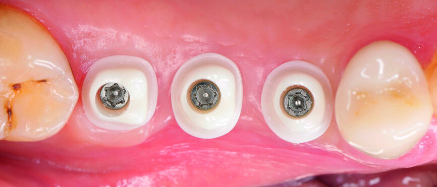 Fig. 22 : Essayage des piliers.