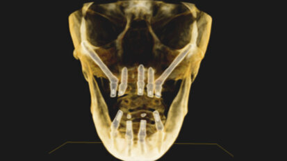 Implantes zigomáticos en la práctica común de la odontología