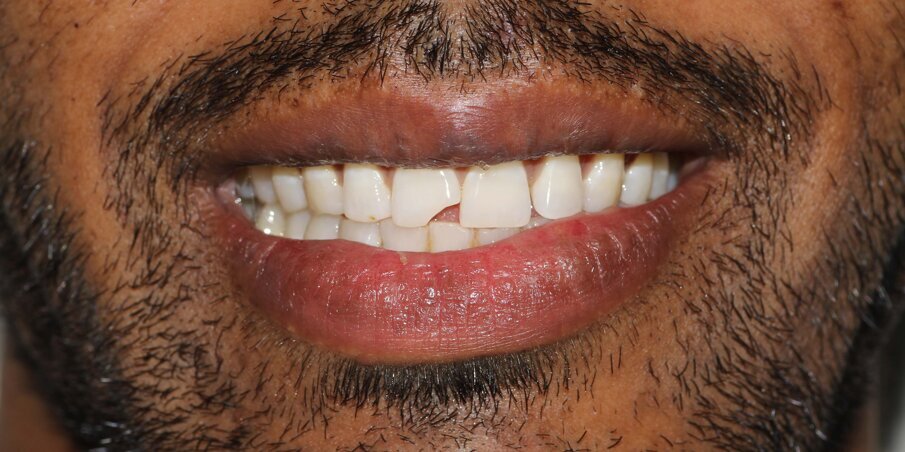 Fig 1: Pre op Smile