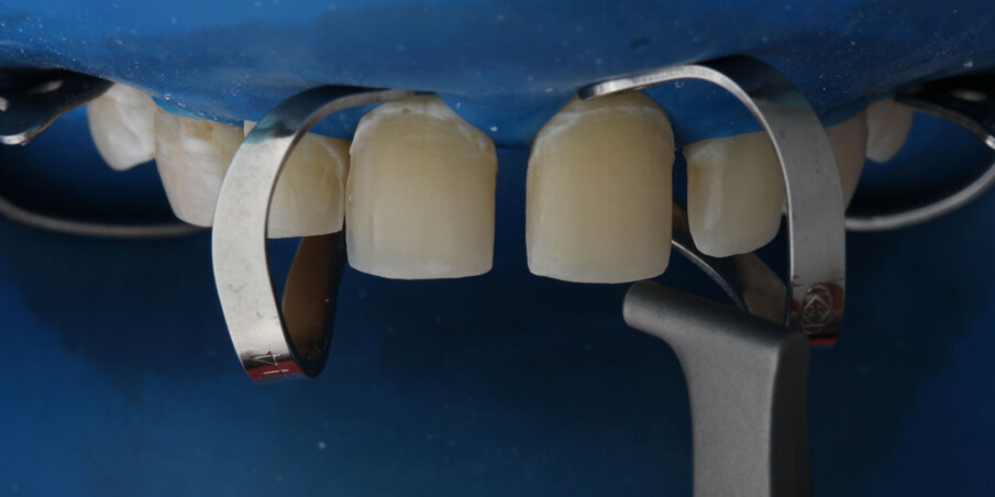 Case 2: Used prior to bonding Indirect Restorations