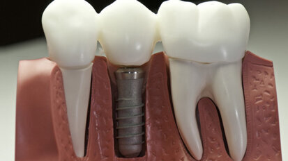 Bessere Osseointegration durch Speichelpeptide