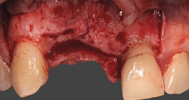 L’aumento del tessuto osseo nei settori estetici con utilizzo di griglie customizzate e Geistlich Mucograft