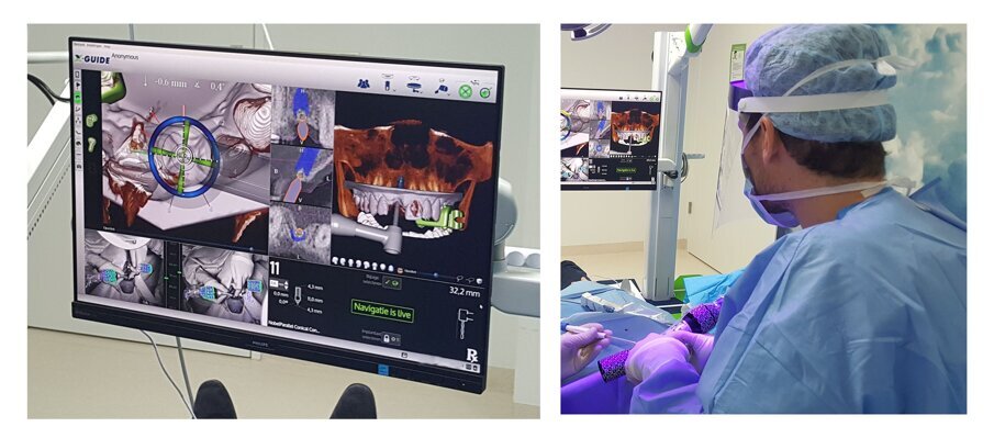 Afbeelding 3. Navigatie met behulp van het X-Guide Systeem (Nobel Biocare) voor het nauwkeurig plaatsen van implantaten. De chirurg ziet de virtuele preoperatieve planning en kan zijn handstuk exact aanpassen om deze planning te realiseren en de implantaten op de exact geplande locatie te plaatsen.
