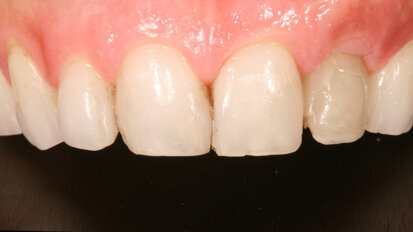 Top three trends influencing U.S. dental bone grafting industry in 2021
