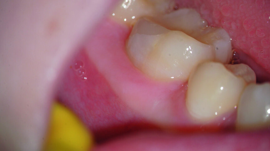 Fig. 9: Completely healed mucosa and no swelling after three months.